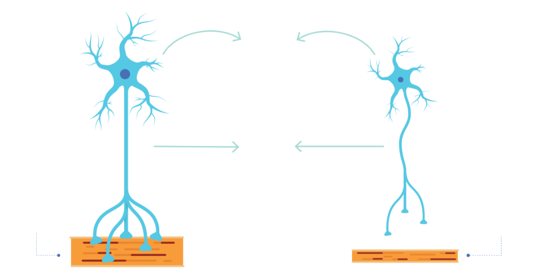 Degeneracija motoričkih neurona dovodi do postupnog smanjivanja mišićne mase i snage (atrofija).